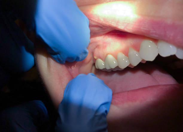 Best Emergency Dental Care for Abscessed Tooth in South Windham, CT